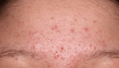 Skin of 13-year-old Asian female at Week 8 of Phase 3