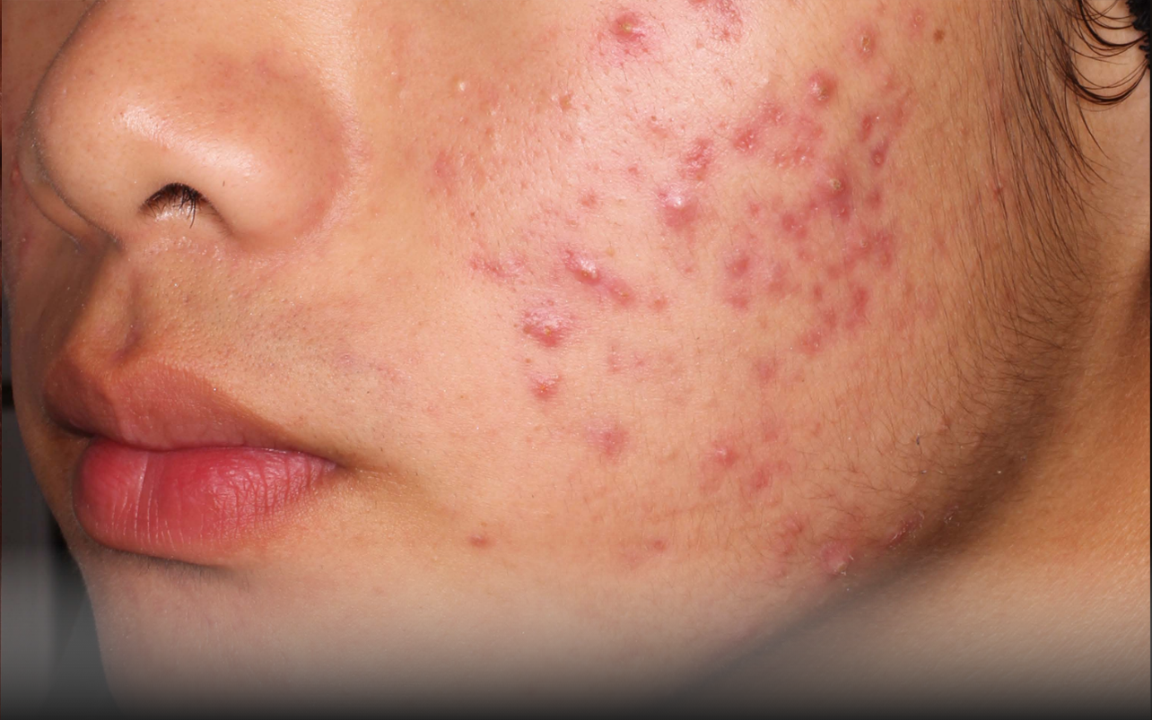 Skin of 14-year-old Asian male at Week 0 of Phase 2