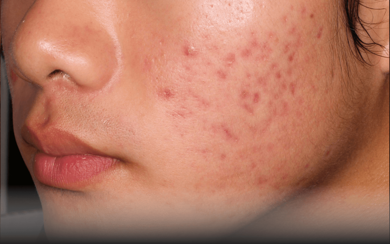 Skin of 14-year-old Asian male at Week 4 of Phase 2