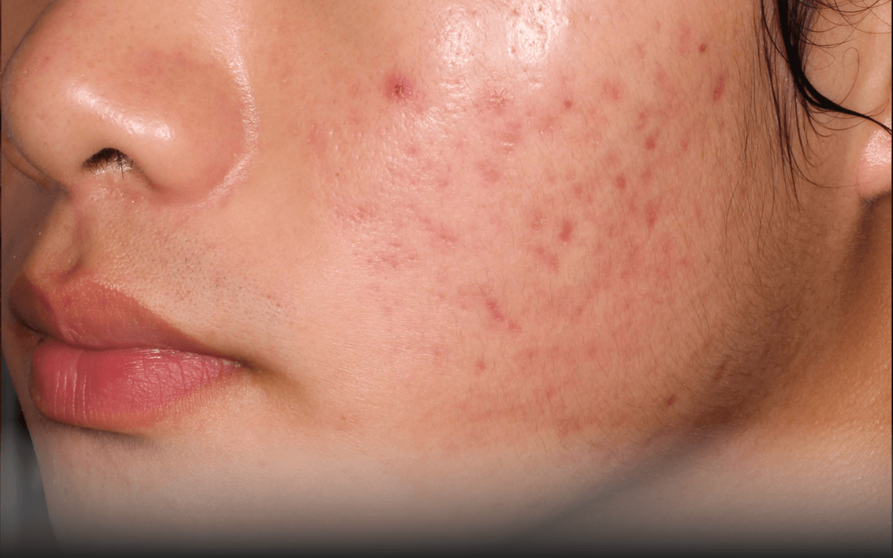 Skin of 14-year-old Asian male at Week 8 of Phase 2