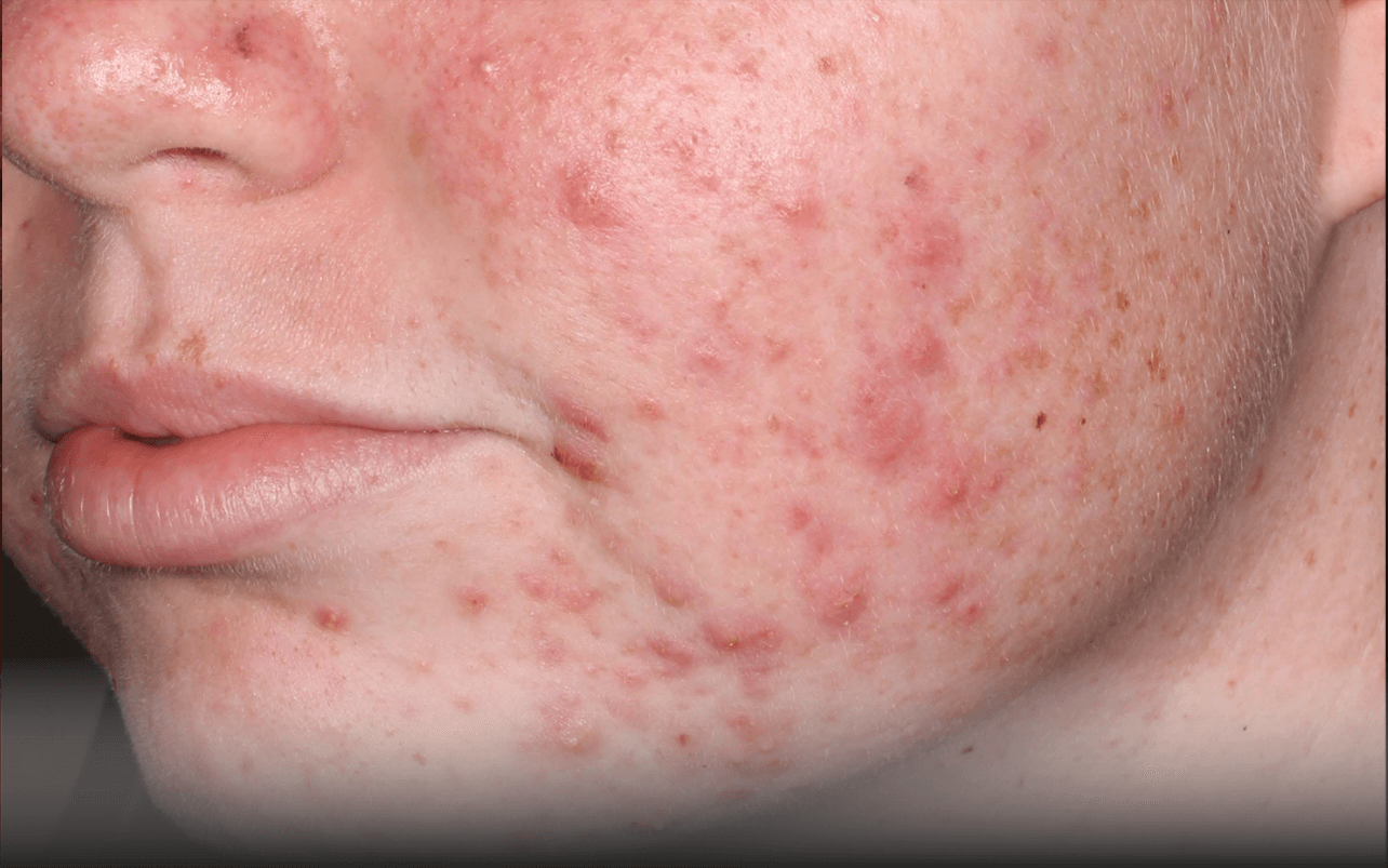 Skin of 14-year-old White female at Week 0 of Phase 3
