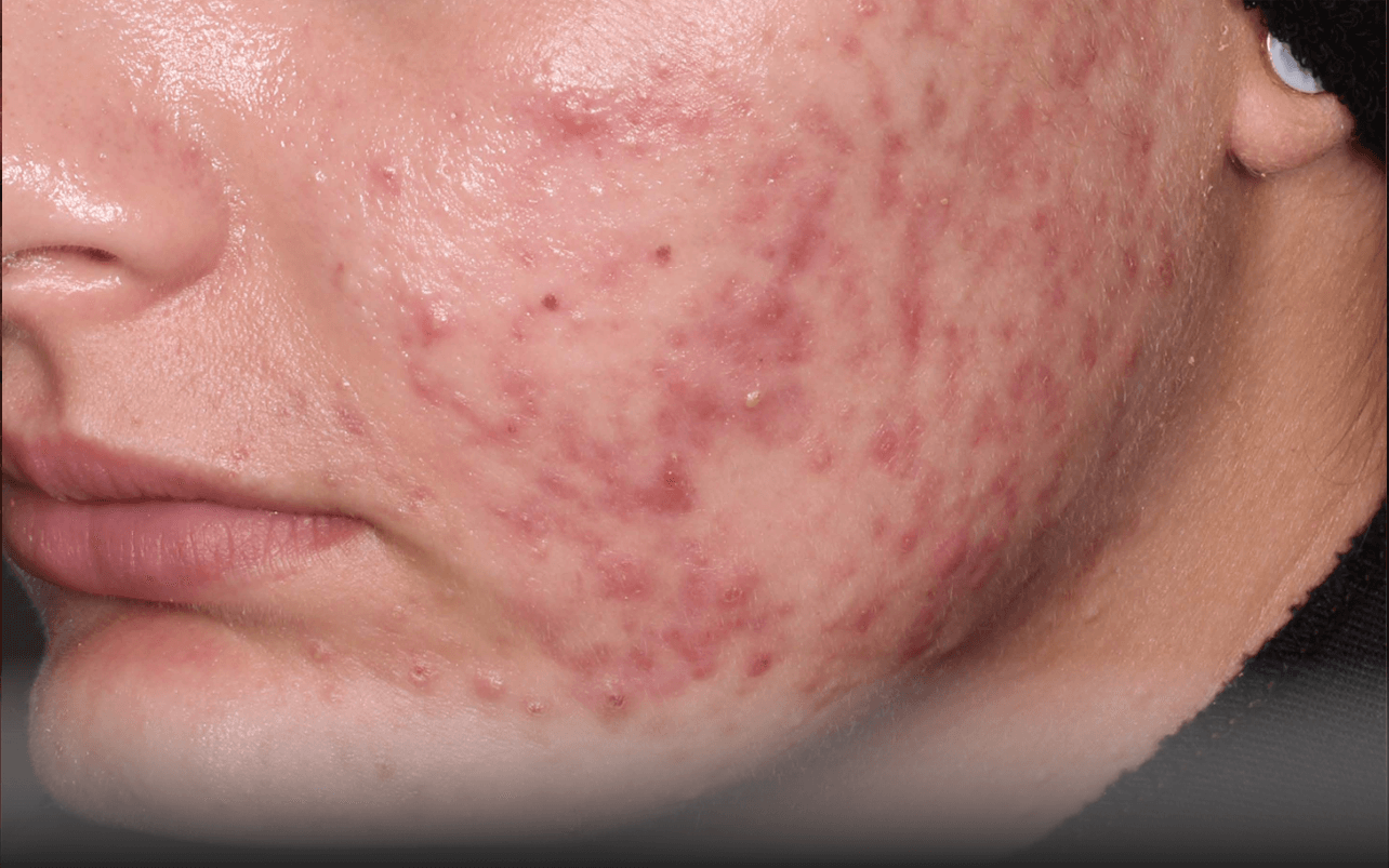 Skin of 17-year-old White female at Week 4 of Phase 3