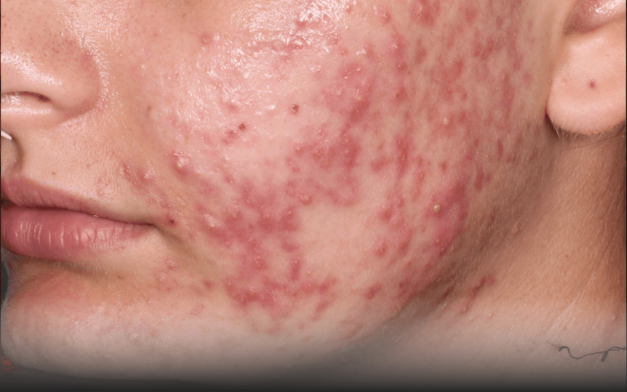 Skin of 17-year-old White female at Week 0 of Phase 3