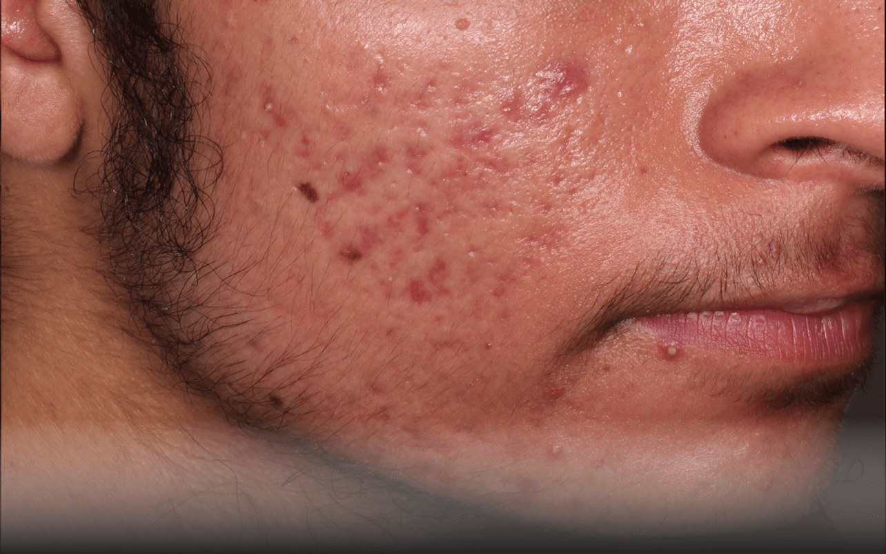 Skin of 18-year-old Asian male at Week 4 of Phase 3