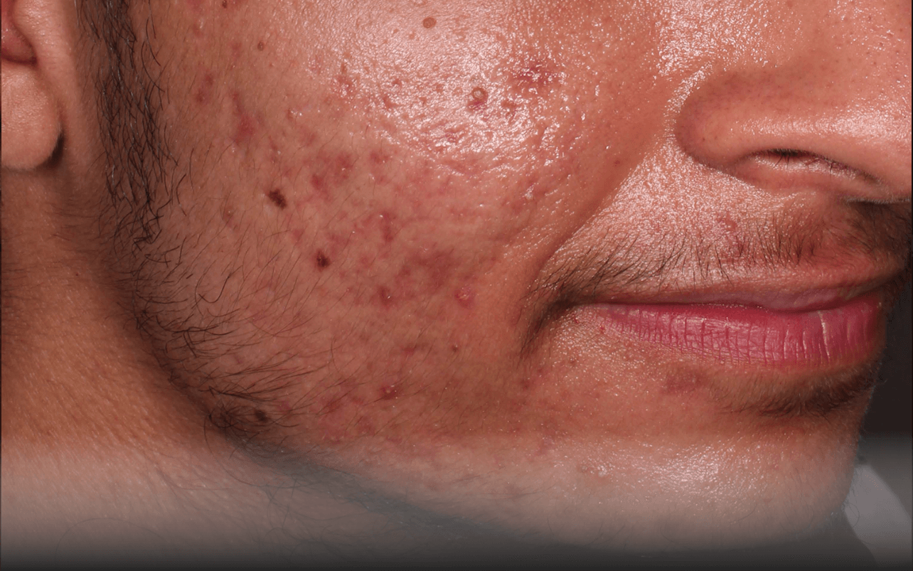 Skin of 18-year-old Asian male at Week 8 of Phase 3