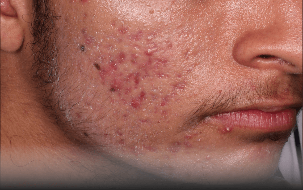 Skin of 18-year-old Asian male at Week 0 of Phase 3