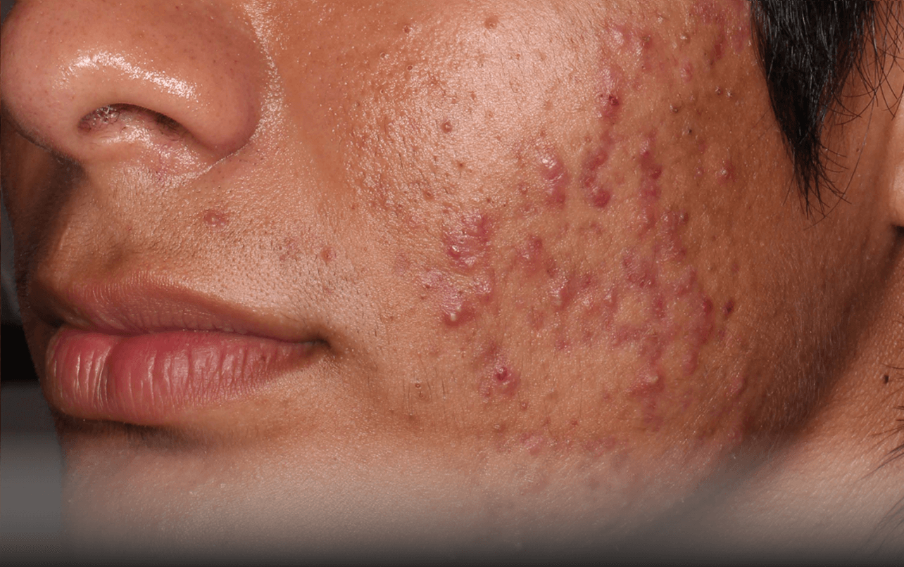 Skin of 18-year-old Hispanic male at Week 0 of Phase 3