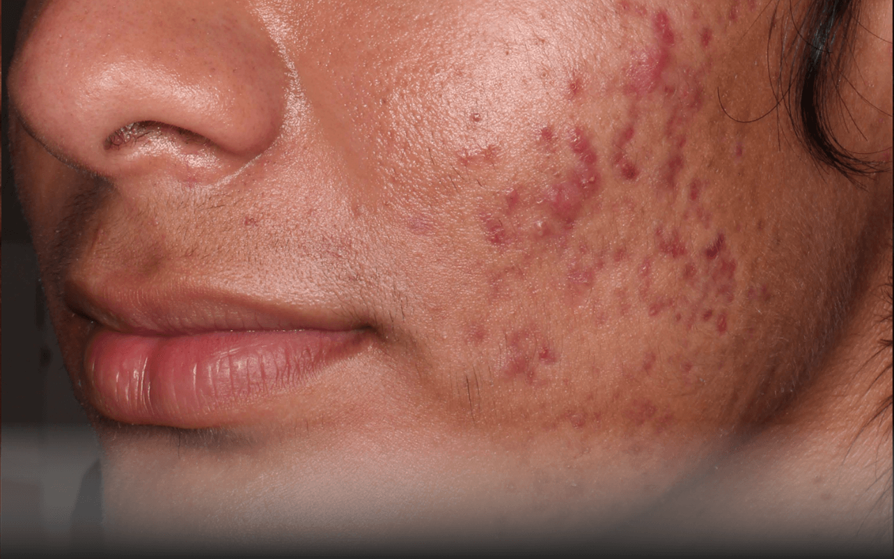 Skin of 18-year-old Hispanic male at Week 4 of Phase 3