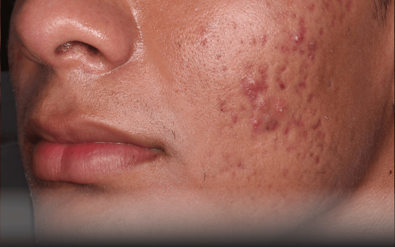 Skin of 18-year-old Hispanic male at Week 8 of Phase 3