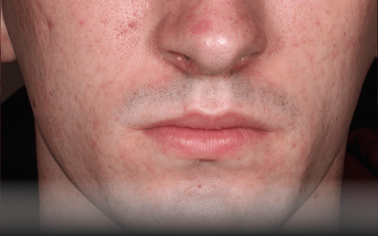 Skin of 18-year-old White male at Week 12 of Phase 3