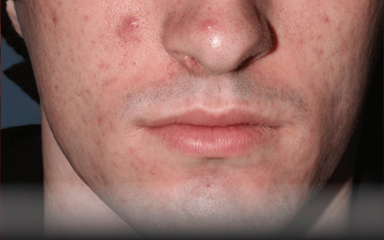 Skin of 18-year-old White male at Week 4 of Phase 3