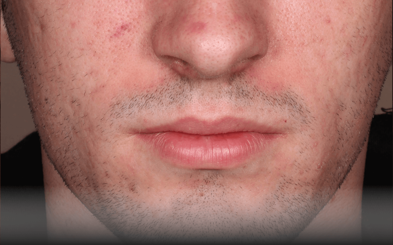 Skin of 18-year-old White male at Week 8 of Phase 3