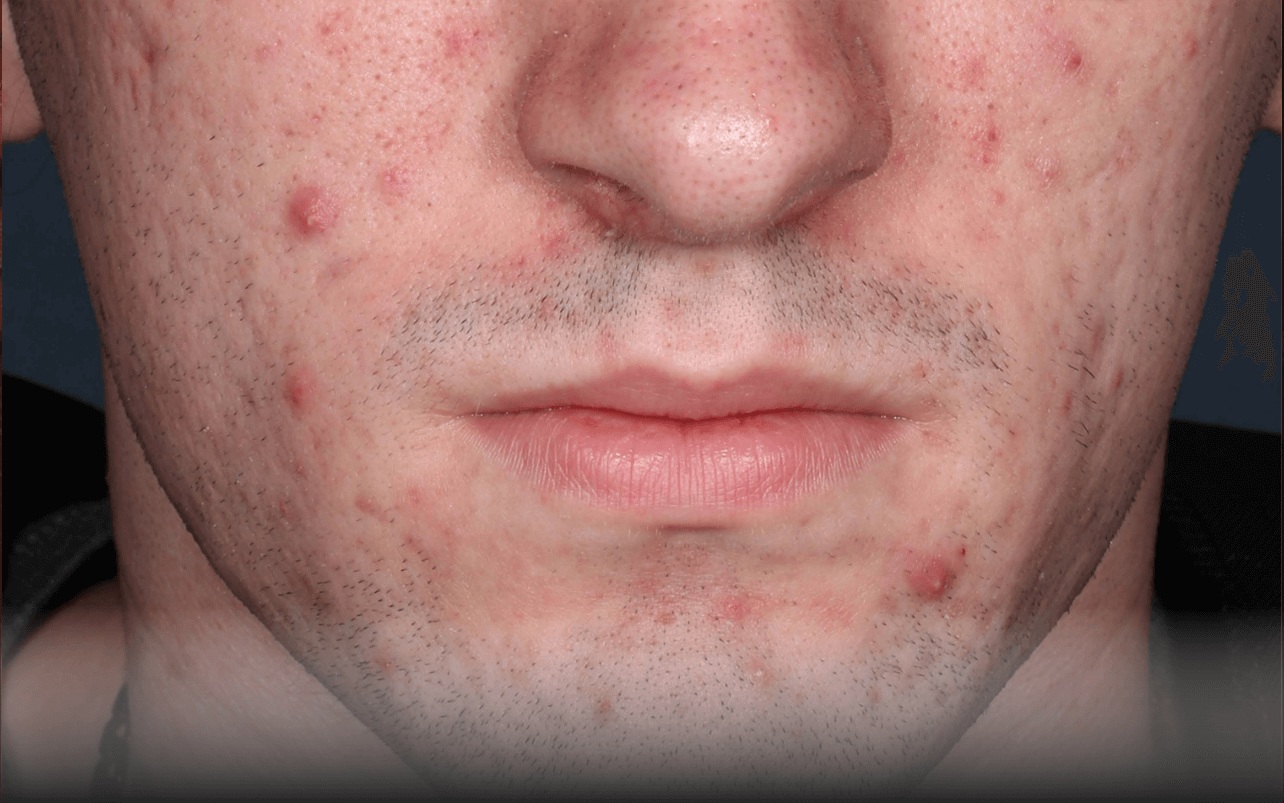 Skin of 18-year-old White male at Week 0 of Phase 3