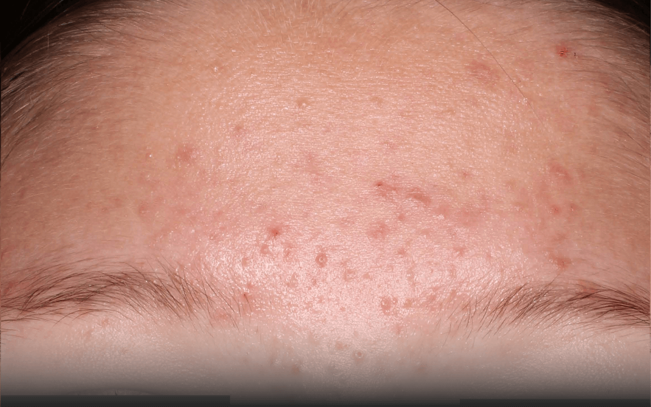 Skin of 13-year-old Asian female at Week 4 of Phase 3