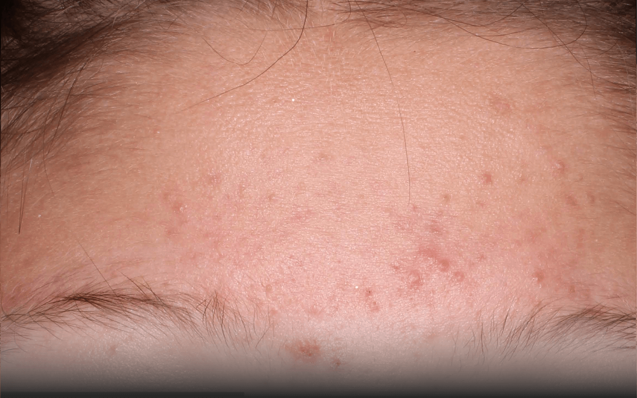 Skin of 13-year-old Asian female at Week 8 of Phase 3