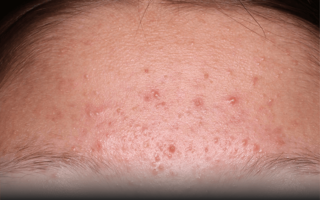 Skin of 13-year-old Asian female at Week 0 of Phase 3