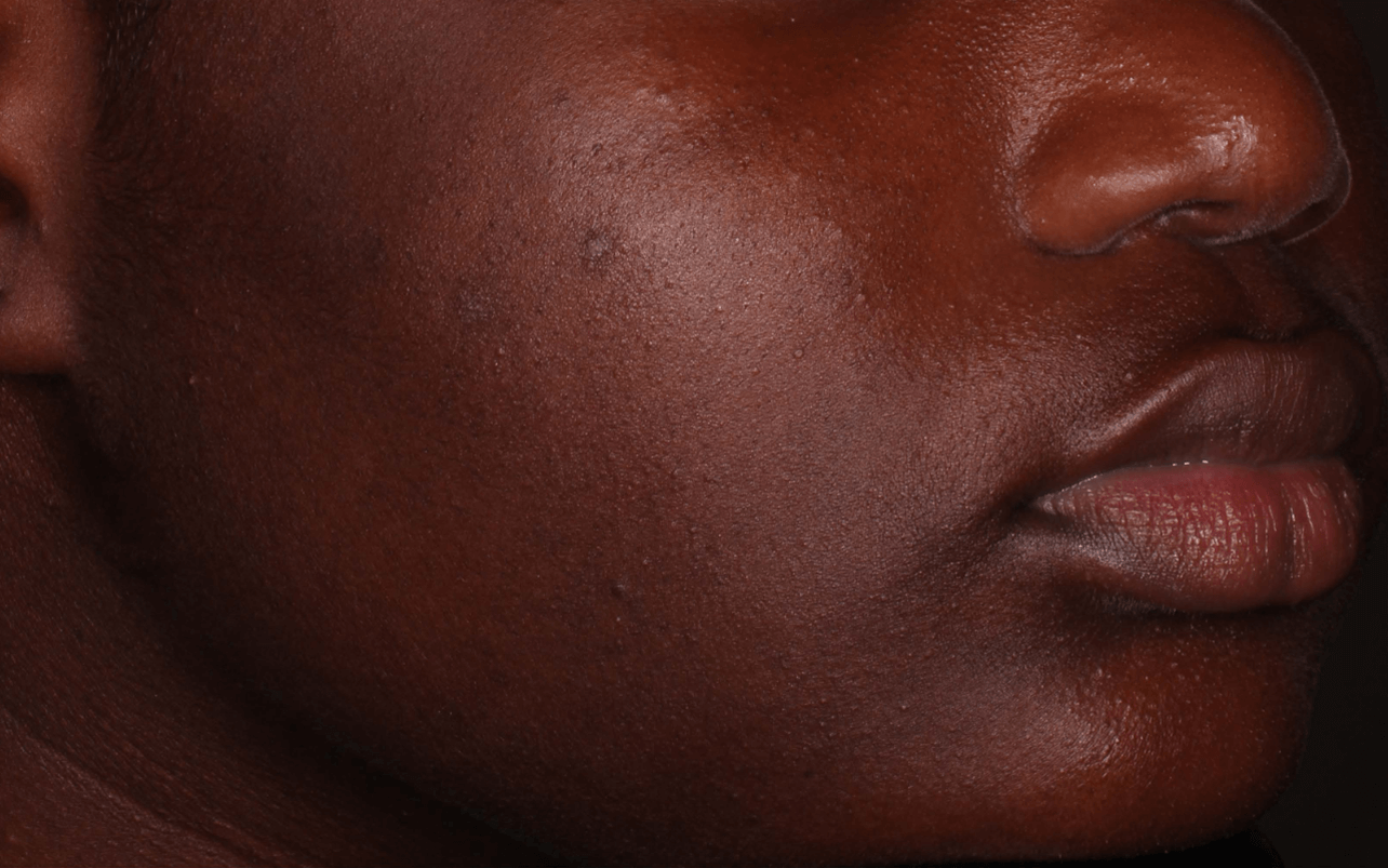 Skin of 13-year-old Black female at Week 12 of Phase 2