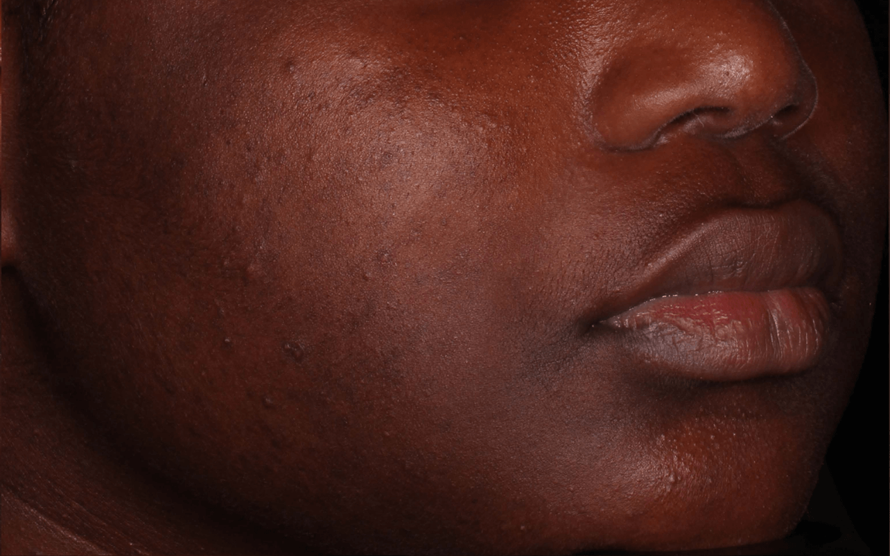 Skin of 13-year-old Black female at Week 4 of Phase 2