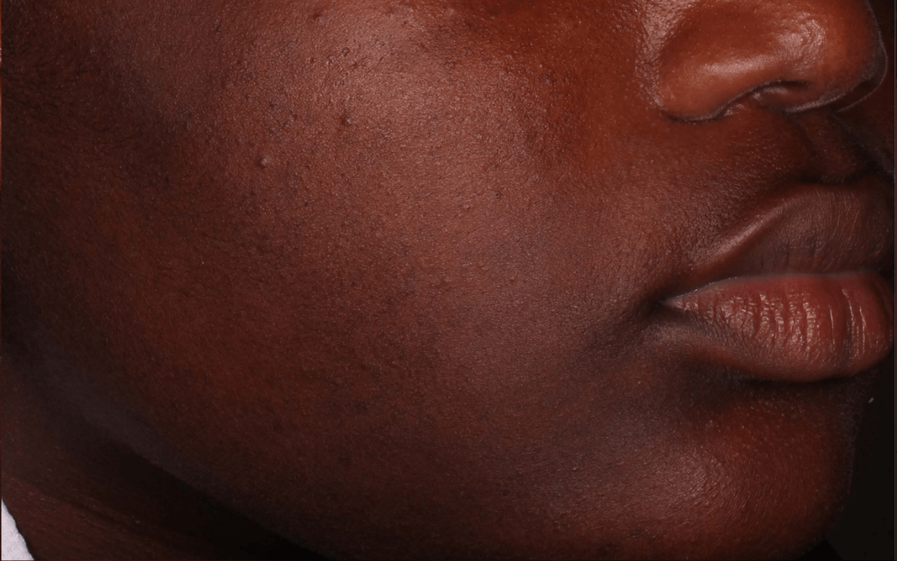 Skin of 13-year-old Black female at Week 8 of Phase 2