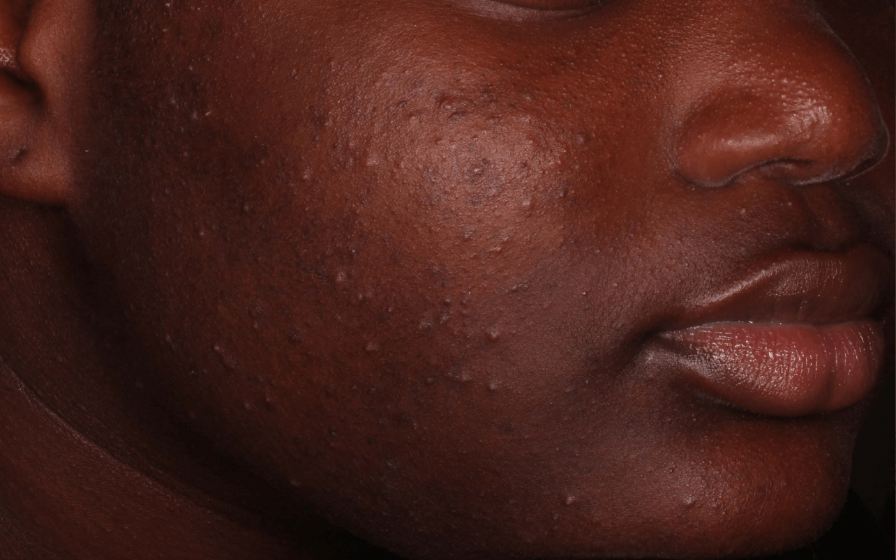 Skin of 13-year-old Black female at Week 0 of Phase 2