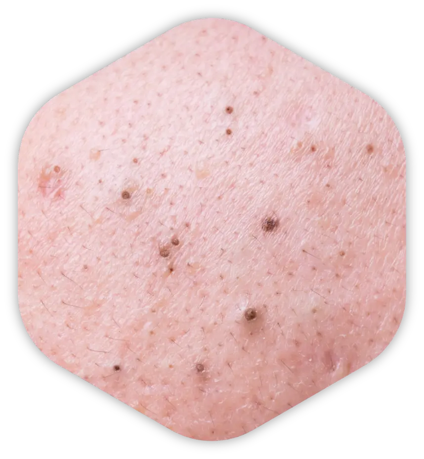 Skin showing noninflammatory blackheads