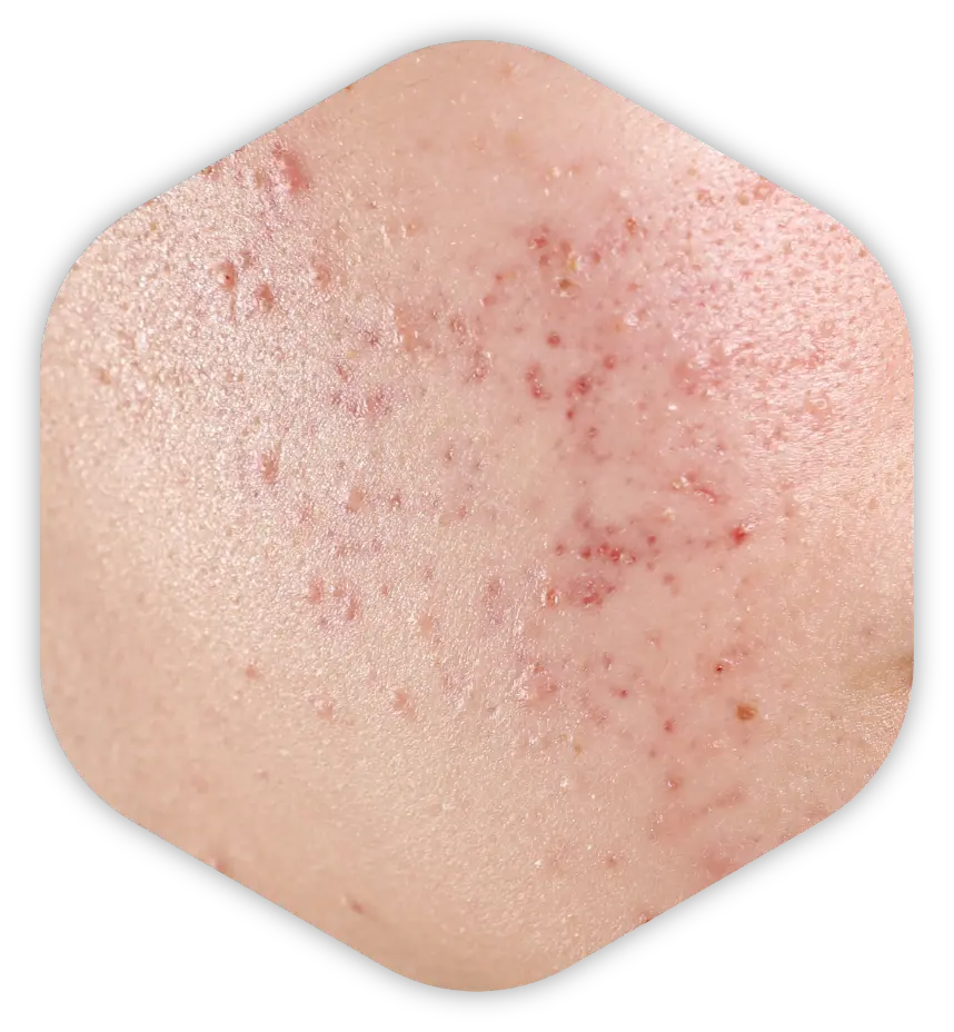 Cheek skin showing papules