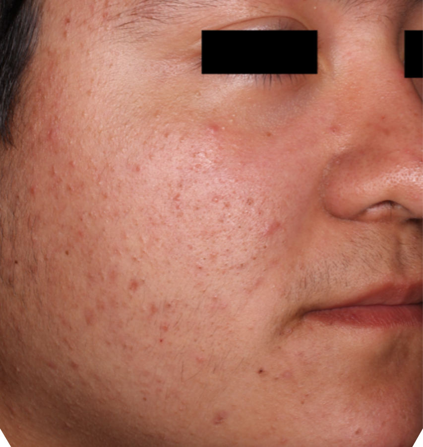 Before-and-after image of CABTREO patient