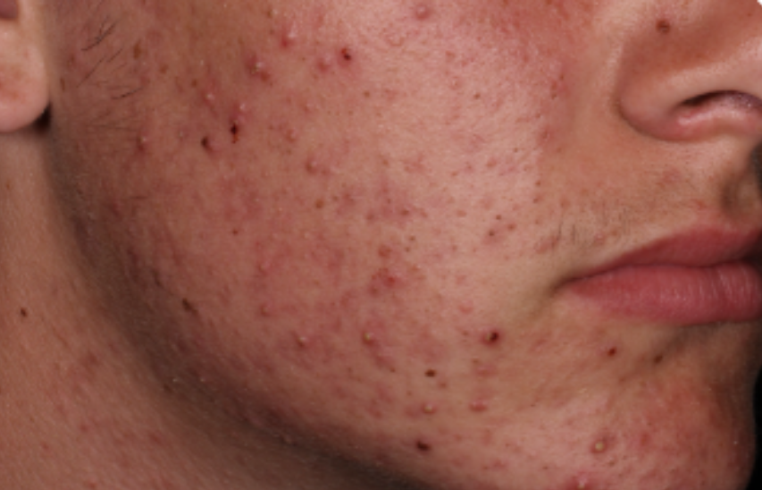 Before-and-after images of a CABTREO patient