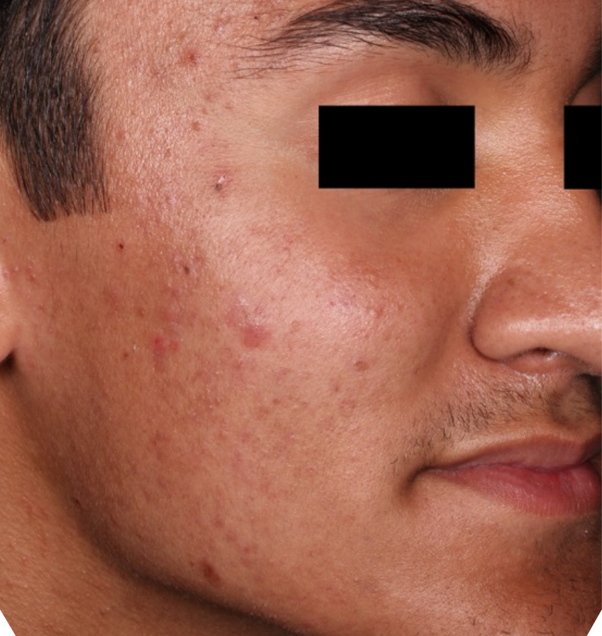 Before-and-after image of CABTREO patient