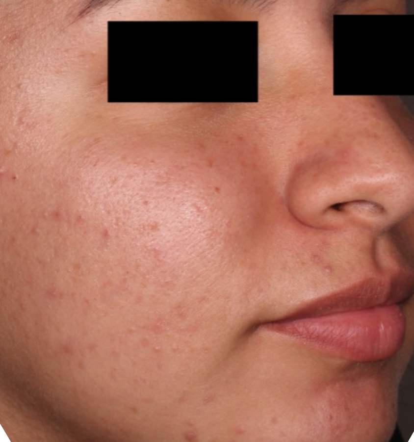 Before-and-after image of CABTREO patient