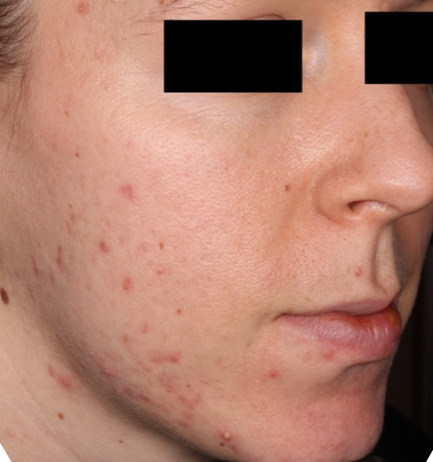 Before-and-after image of CABTREO patient