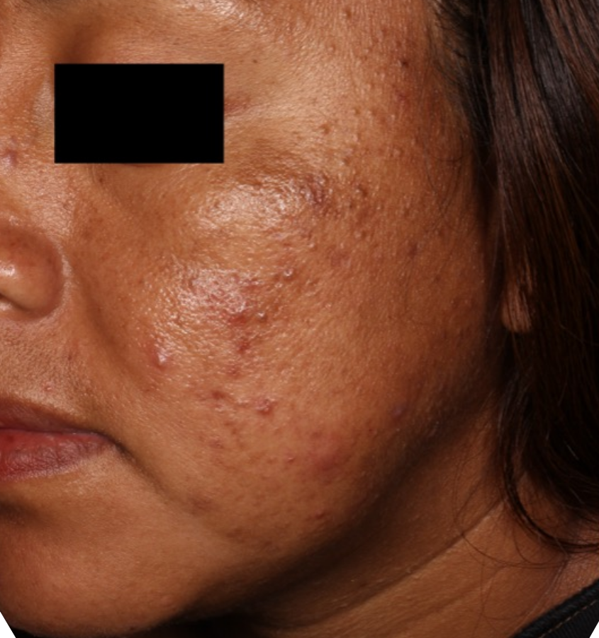 Before-and-after image of CABTREO patient