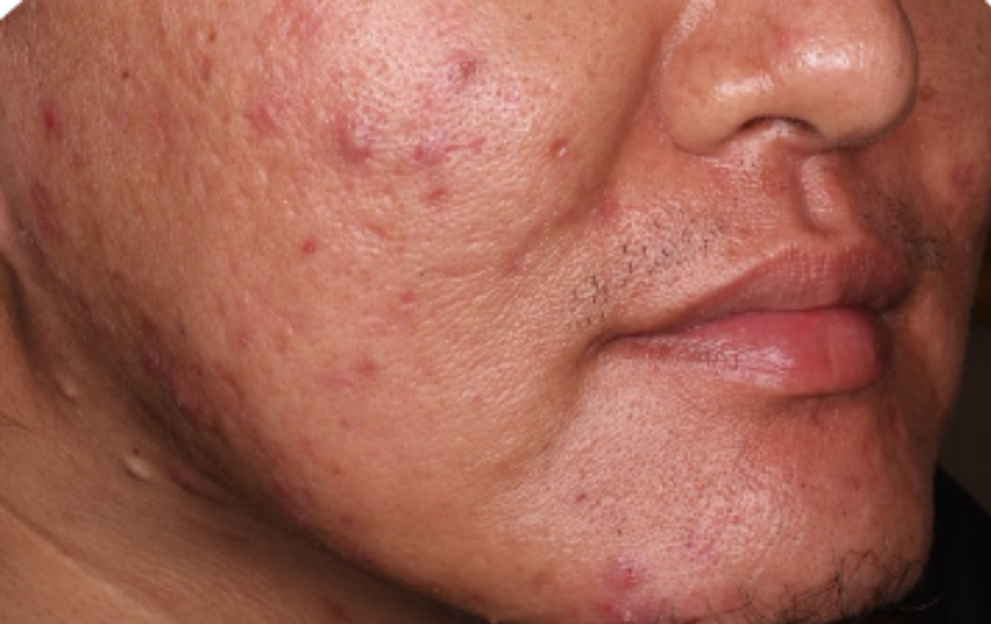 Before-and-after images of a CABTREO patient