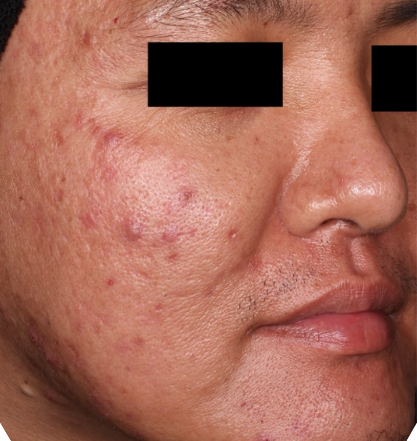 Before-and-after image of CABTREO patient